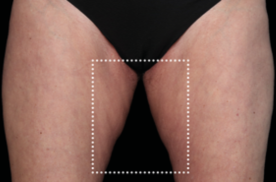 female thighs