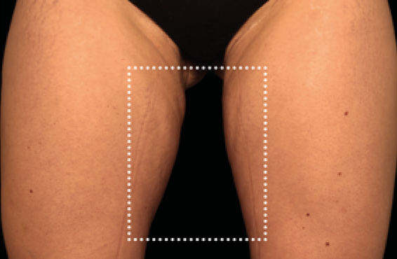 female thighs