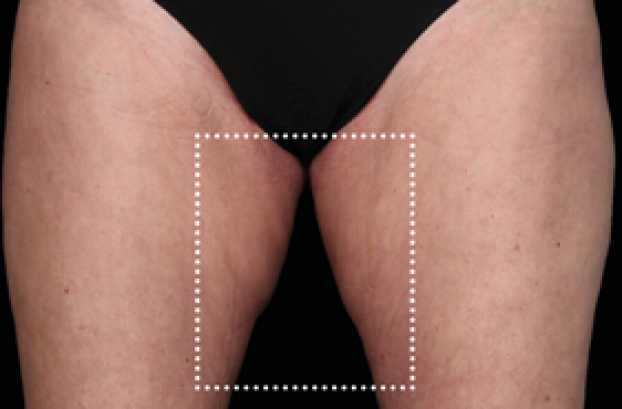 female thighs