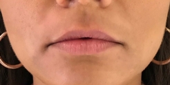 woman before lip filler