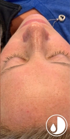 VI Peel treatment