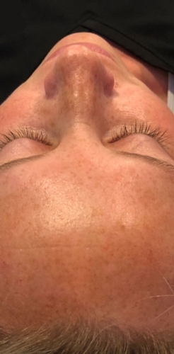 VI Peel treatment