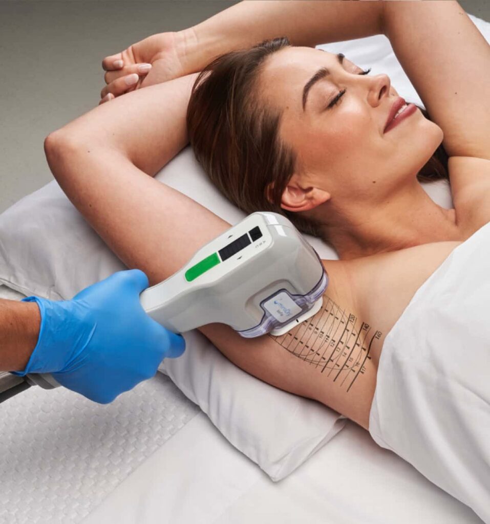 laser hair removal treatment