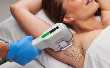 laser hair removal treatment